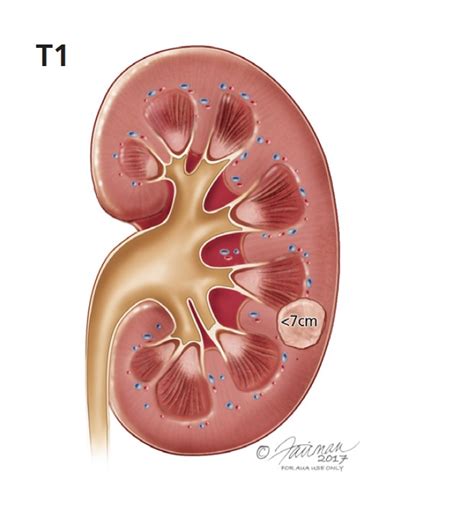 Kidney Tumor Ultrasound