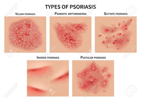 psoriasis and tattoos problems - Reatha Espinal