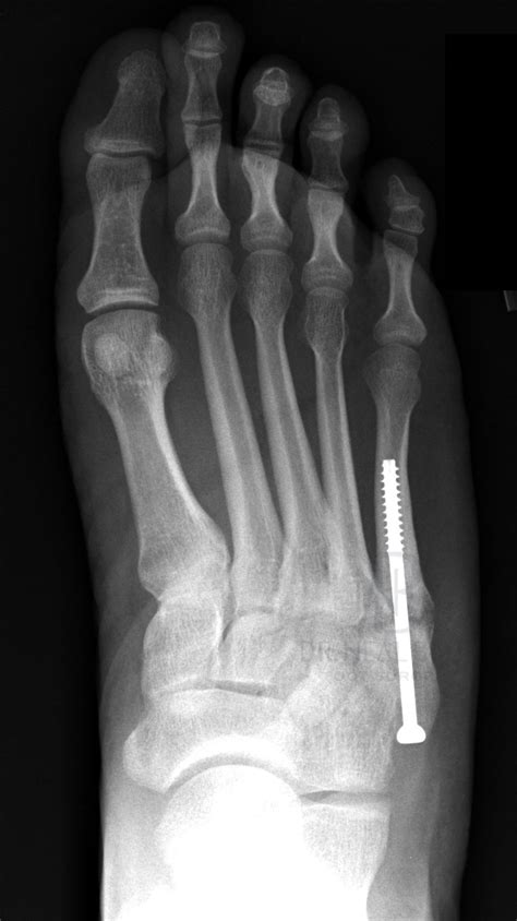 Fifth Metatarsal Fracture Treatment And Tips / Metatarsal Fractures Orthopaedia : This chapter ...