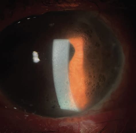 Scleral Edema