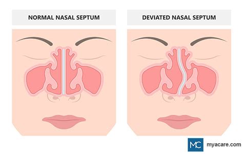 DEVIATED SEPTUM: SYMPTOMS, DIAGNOSIS, AND TREATMENT | Mya Care