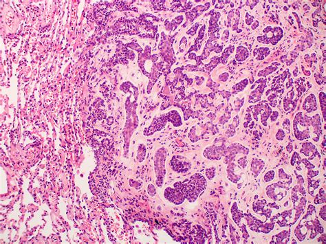 Adenoid Cystic Carcinoma Histology