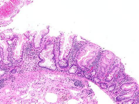 Sessile Polyp Histology