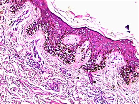 Pathology Outlines - Dysplastic nevus