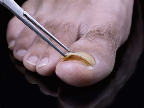 Toenail fungus treatment - Atlanta Podiatrists: Atlanta Foot and Ankle Specialists