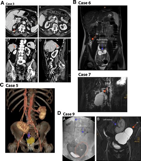 Case 3: (a) Transversal contrast-enhanced CT of a supernumerary kidney... | Download Scientific ...