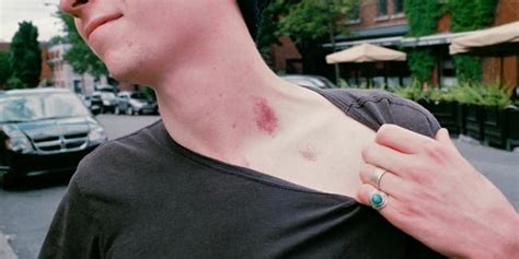 Science Explains How a Hickey Can Kill You | Inverse