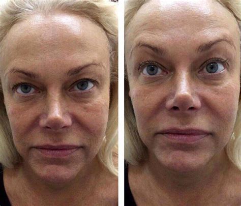 Facelift Hifu Smas Lifting Before And After » Facelift: Info, Prices, Photos, Reviews, Q&A