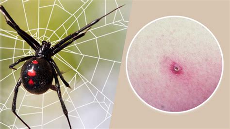 Black Widow Spider Bite Stages: Symptoms and Recovery