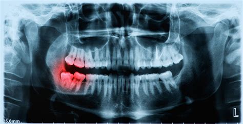 Panoramic x-ray image of teeth and mouth with wisdom teeth | Parkview ...