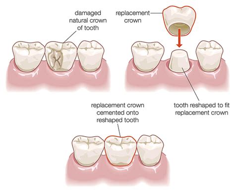 Cracked tooth syndrome : Indications, Treatments and Precautions – Sabka Dentist – Top Dental ...