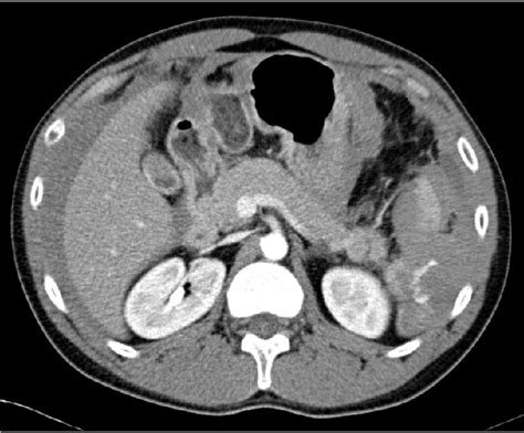 Abdominal CT scan: Grade IV splenic injury with contrast blush and... | Download Scientific Diagram