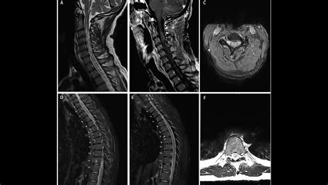 Spinal Cord Lesions - The Neurology Hub