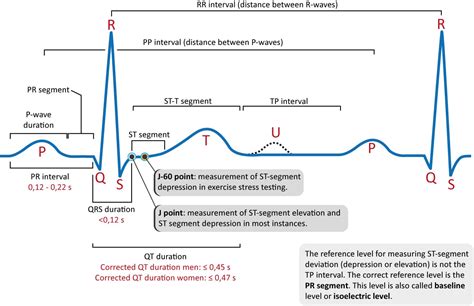 ECG interpretation: Characteristics of the normal ECG (P-wave, QRS ...