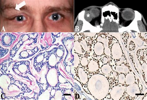 Adenoid Cystic Carcinoma Adalah