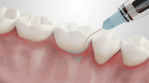 Oraqix Dispenser & Periodontal Gel | Dentsply Sirona USA