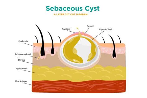 10 Symptoms and Treatments of Sebaceous Cysts - Health & Detox & Vitamins