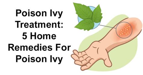 Poison Ivy Treatment: 5 Home Remedies For Poison Ivy - David Avocado Wolfe