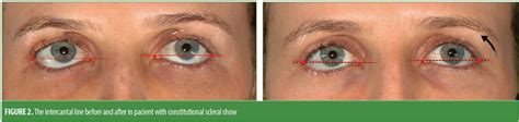 Use of Hyaluronic Acid Fillers to Correct Scleral Show: A Review of Technique : JCAD | The ...