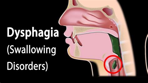 Dysphagia - Causes, Symptoms, Diagnosis, Diet & Treatment