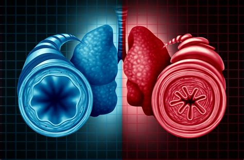 Lack of Uniform Asthma-COPD Overlap Definition Creates Treatment ...