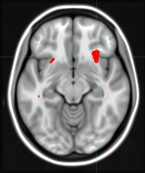 Brain Scan May Predict Best Depression Treatment | National Institutes of Health (NIH)