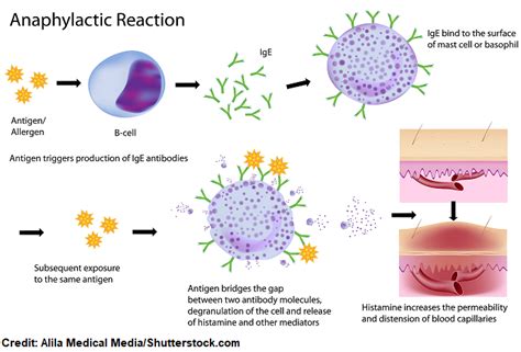 Anaphylactic Shock NCLEX Review