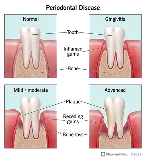 Understanding Different Types of Gum Disease – Influential Smiles