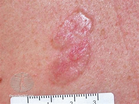 Basal-cell-carcinoma | Epiphany Dermatology