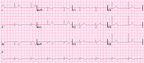 Dr. Smith's ECG Blog: Chest pain and Inferior T-wave Inversion. Does ...