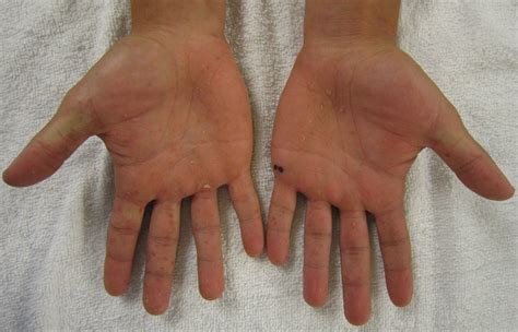 File:Characteristic rash of hand, foot, and mouth disease, on two humans hands.jpg - Wikimedia ...