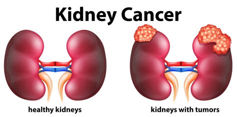 Studies On Cannabis And Kidney Cancer