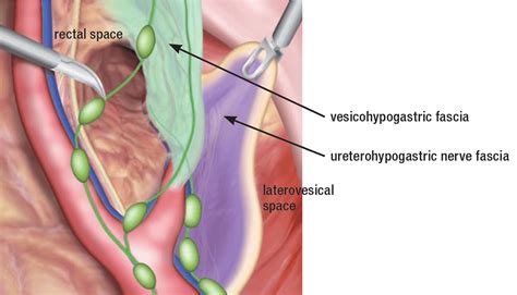 Sentinel Pelvic Lymph Nodes