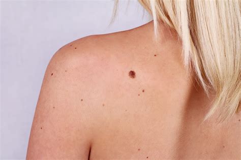 Why Do People Get Moles and Skin Tags? Causes and Treatments