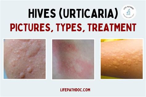 Hives Urticaria Causes Facts Types Symptoms