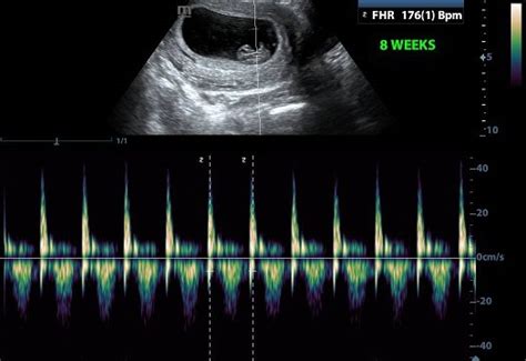 Fetal heart rate at 8 weeks