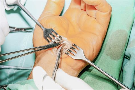 Carpal Tunnel Syndrome Surgery: What to Know Before Surgery