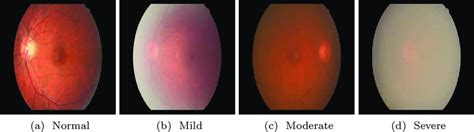 The different stages of cataract according to its severity level.... | Download Scientific Diagram