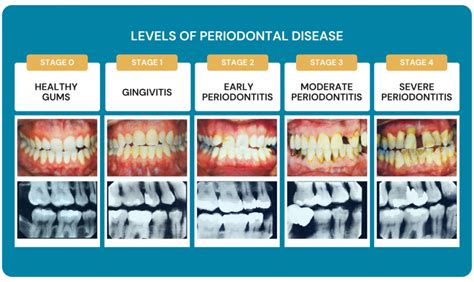 How to Prevent and Manage Gum Disease - Dental Care Stamford