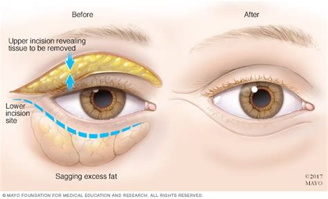 How To Reduce Swelling In Eye - Battlepriority6