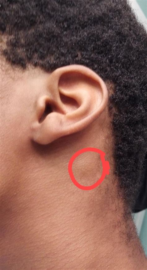 Swollen lymph node behind ear for a month. Should I finally see a doctor? : Swollenlymphnodes