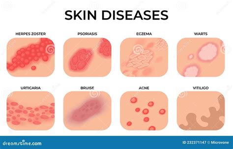 Skin Disease. Different Diseases, Epidermis Surface with Eczema. Dermatology, Allergy Symptoms ...