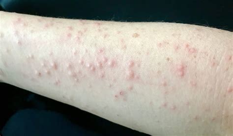 Skin Rash Itchy Red Bumps