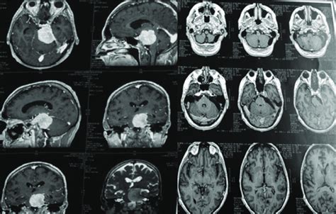 Meningioma petroclival grande resecado por abordaje suboccipital. Se... | Download Scientific ...