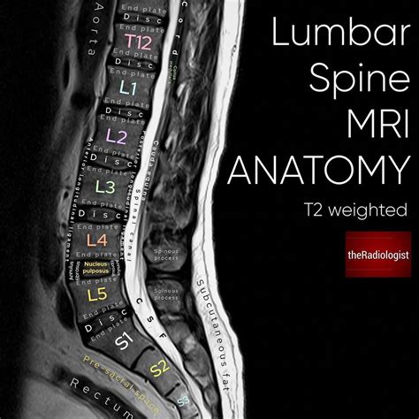 The Radiologist on Instagram: “Sagittal T2 weighted image of an MRI of the lumbar spine ...