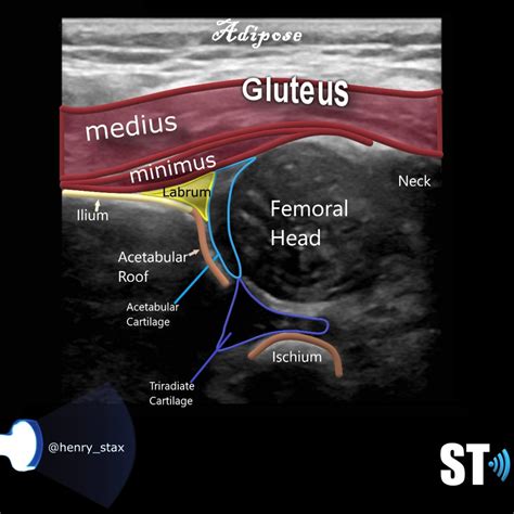 Neonatal Hip Ultrasound – Sonographic Tendencies