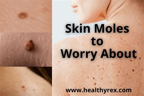 Skin Moles to Worry About – A Complete Guide With Skin Moles Pictures