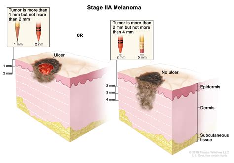 Melanoma Treatment (PDQ®)—Patient Version - National Cancer Institute