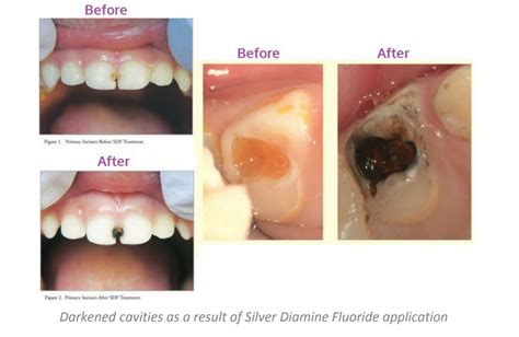 Tooth Decay Treatment Before And After