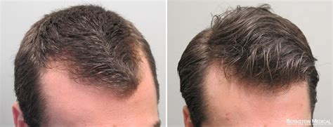 Rogaine for Receding Hairline: 5 Super Important Facts